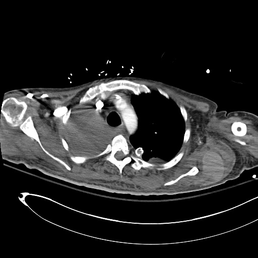 Pleural Effusion Tags Differential Diagnosis of
